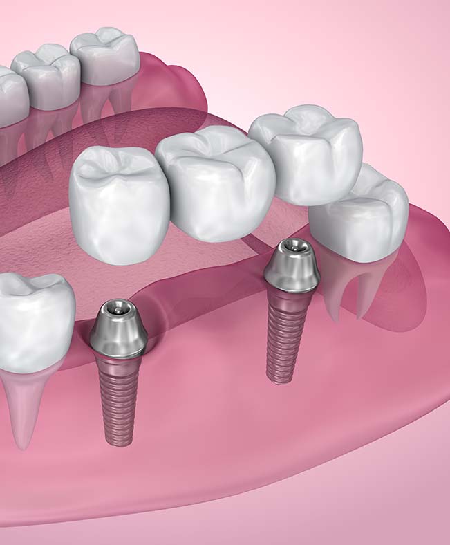 Treatment - Caversham Heights Dental Practice